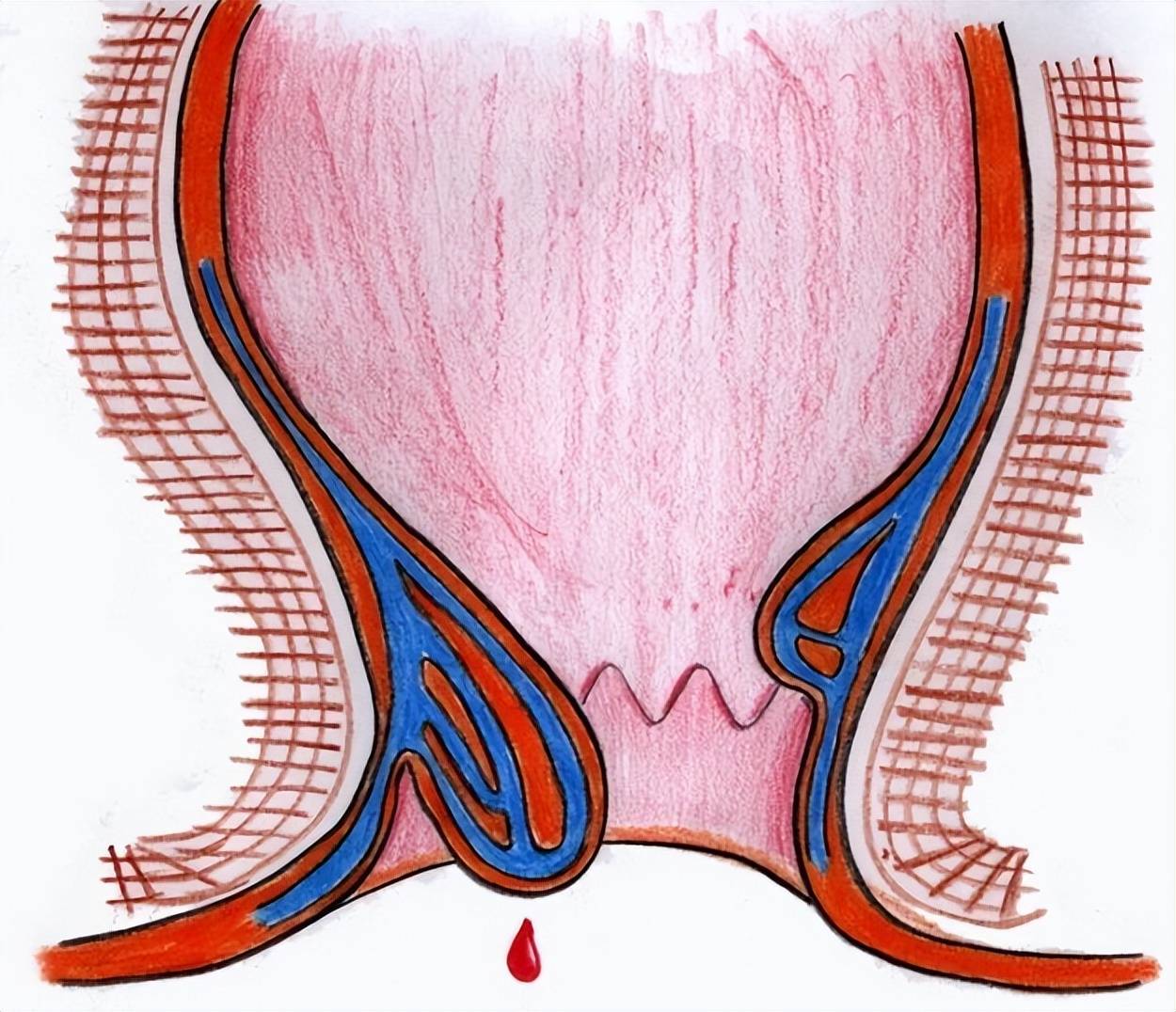 痔疮肉球啥样图片图片