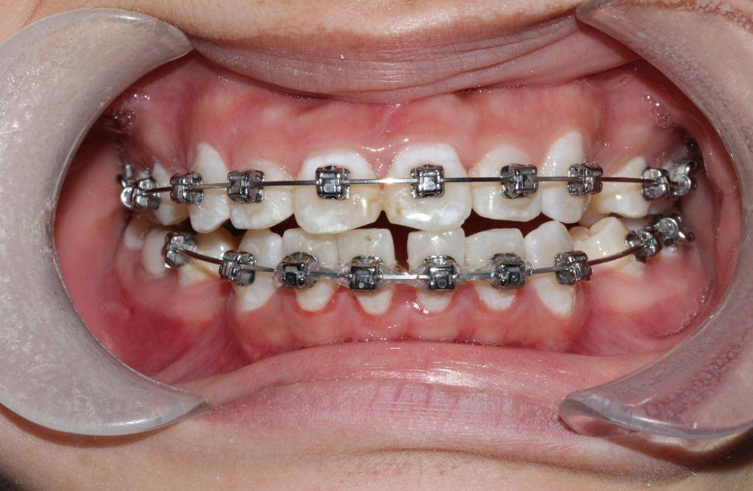 遗传性牙齿不齐矫正一年效果显著,邢台17岁表妹的矫正之旅