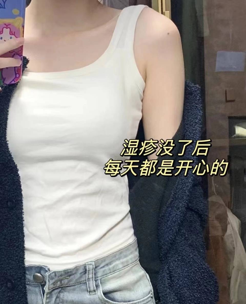 荨麻疹患者必看!这个方法让我彻底康复!