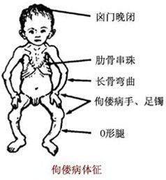 佝偻病于青少年儿童2岁以上病儿可见有鸡胸