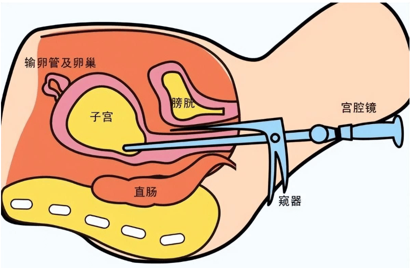 丹东妇科 节育器长肉里?宫腔镜轻巧取环