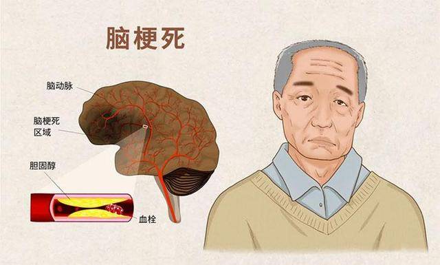 脑梗来临,身体2个月前或有"暗示"?医生:3个表现别再忽视