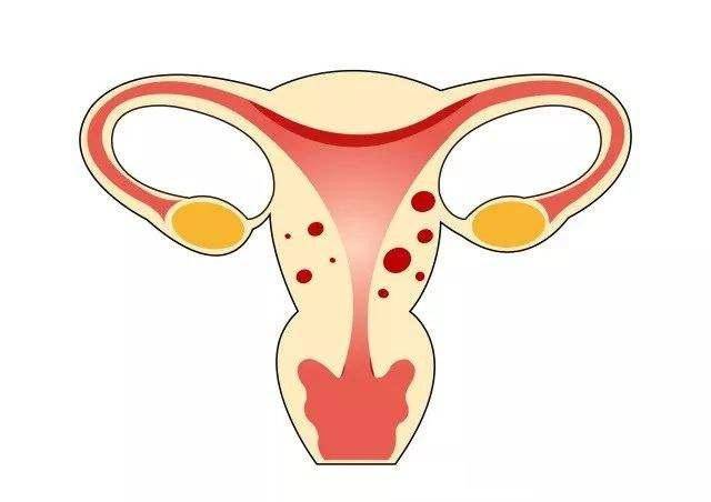 子宫内膜腺肌症是如何发生的?出现这2种症状不要大意了!