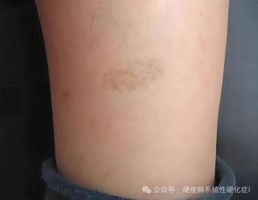 硬皮病症状在不同阶段的变化