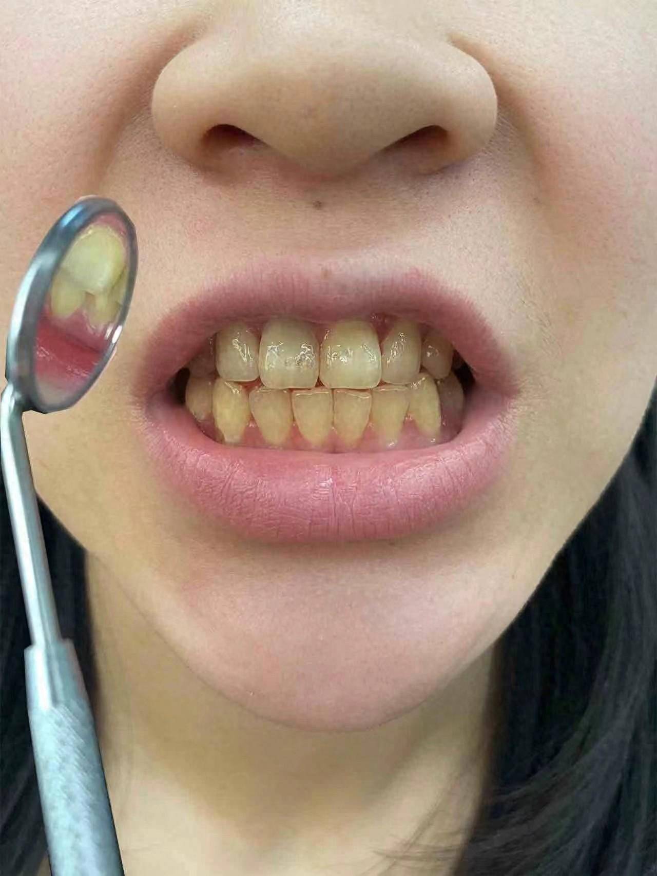 不洗牙在家就能解决黄厚牙结石!后悔没有早知道!