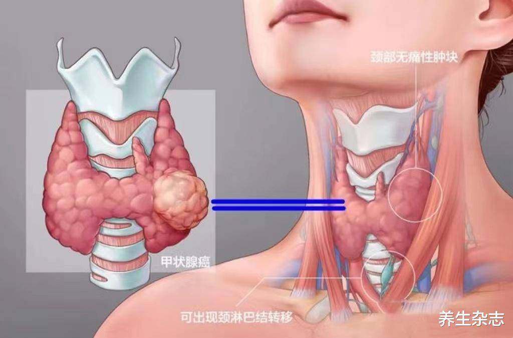 羊肉是结节的催化剂?医生 不想甲状腺报废