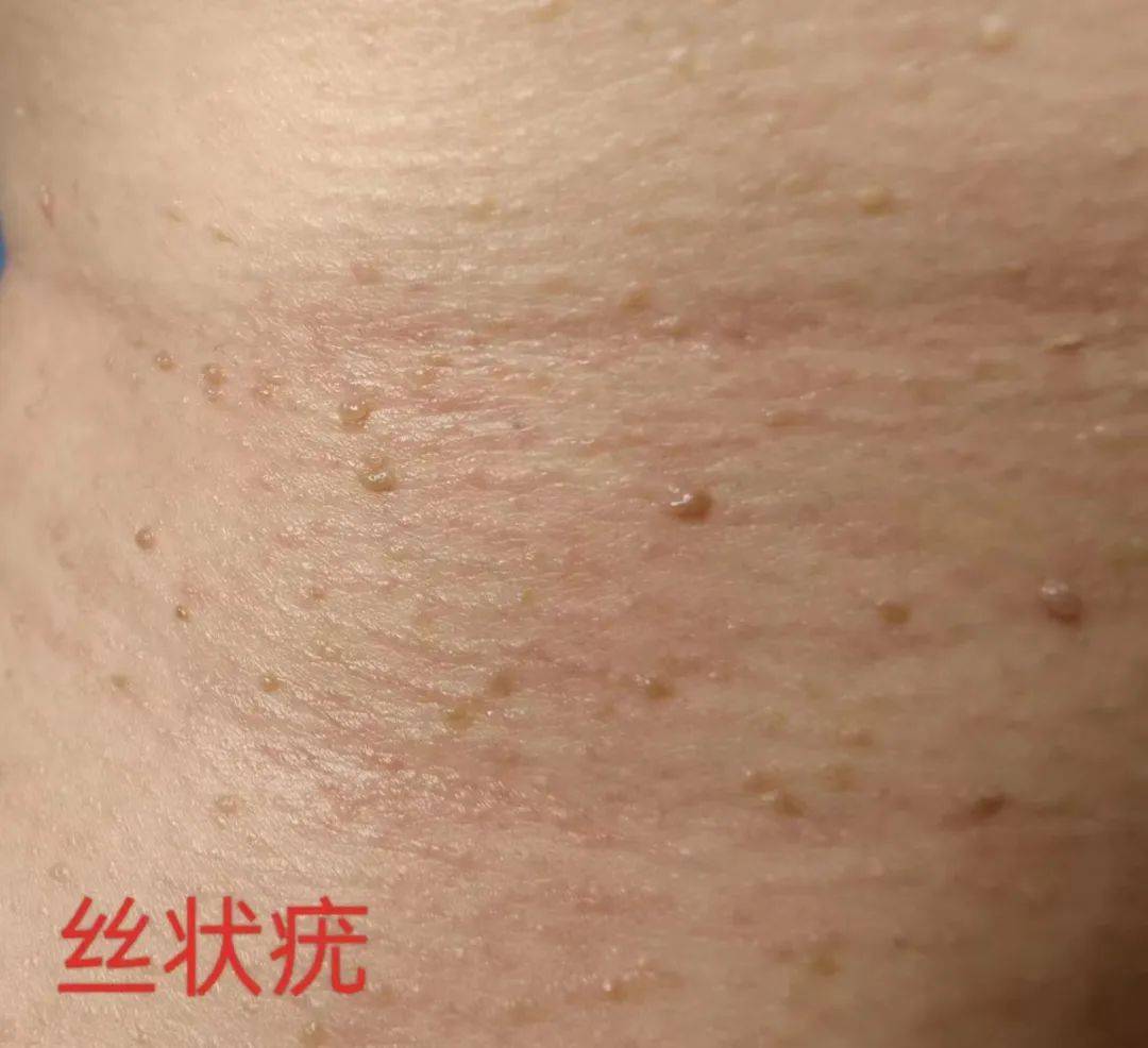 ▌跖疣: 由人乳头瘤病毒(hpv)感染引起的一种皮肤良性增生病变,多发生