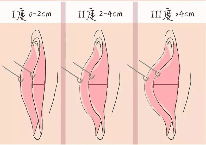 大阴纯粘连图片