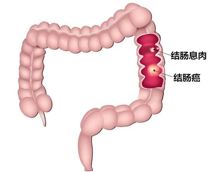 结肠长在哪个位置图片