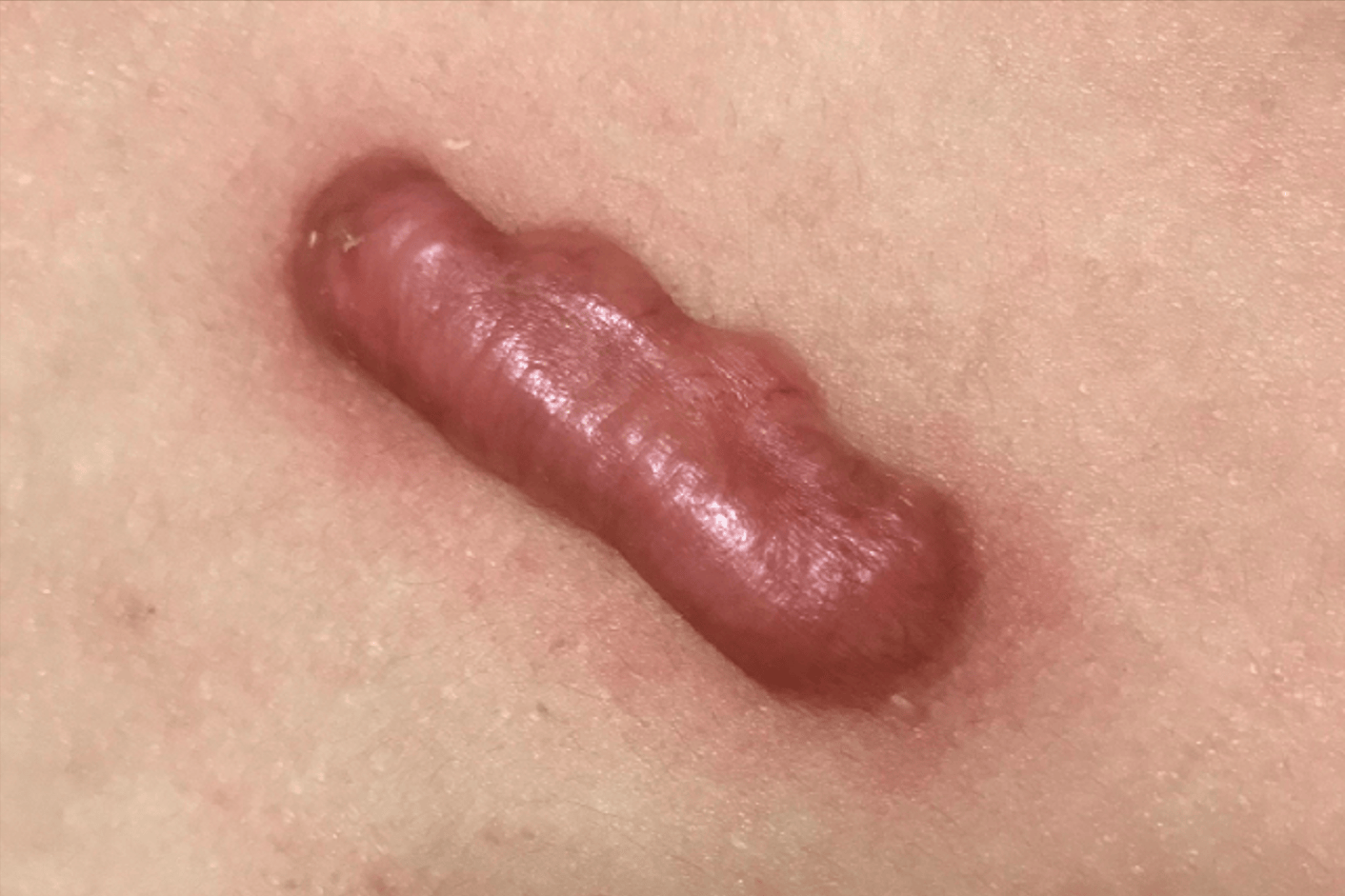 有这个秘密武器,疤痕消失不在话下!