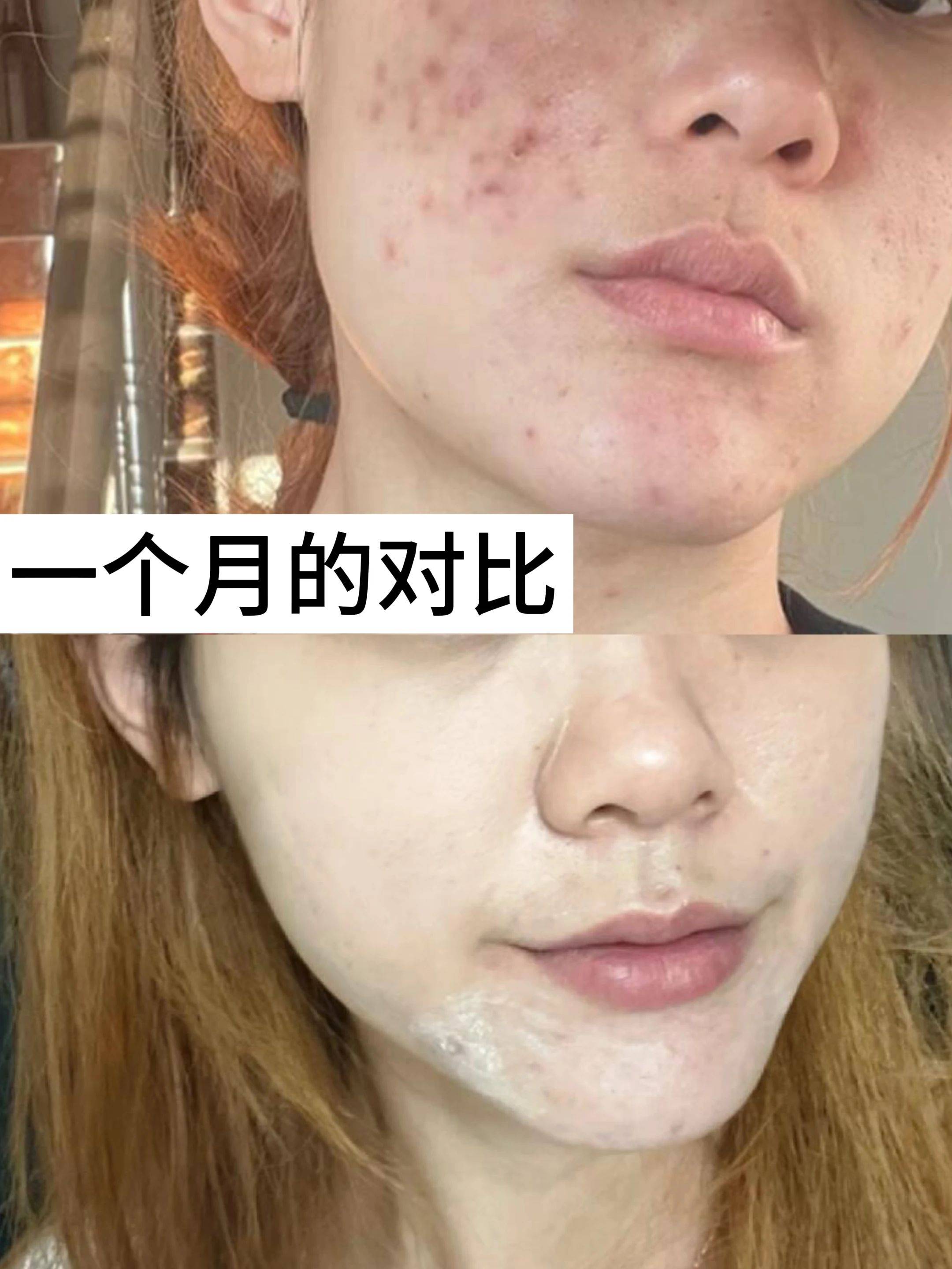 痤疮痘痘终于好了!分享两个祛痘神器,学会祛痘省下一大笔!