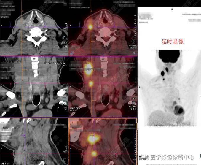 男,69岁,PET/CT寻找原发灶一例_病变_肿瘤_淋巴结