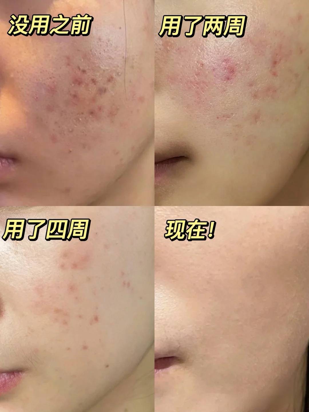 祛痘用什么产品比较好?十款热销祛痘产品新鲜出炉