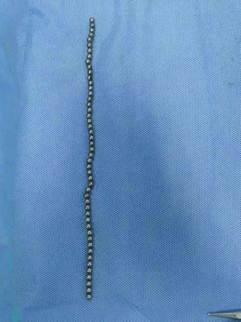 13岁男孩血尿医生取出20多颗磁力珠-13岁小孩尿血这是什么原因引起的