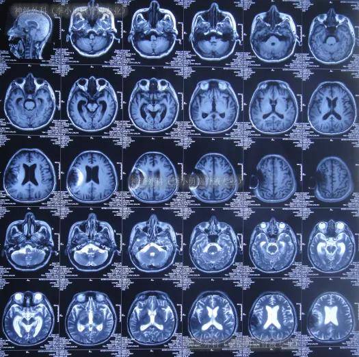 图-9:2022年11月25日头颅ct脑室分流管腹腔端内置术8天即2022年11月25