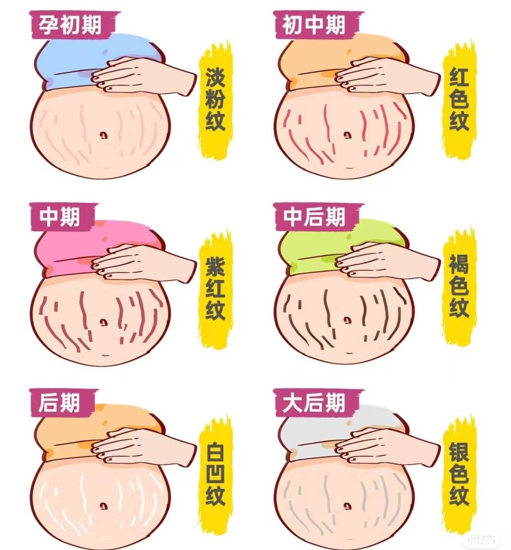 新婚发现妻子有妊娠纹,丈夫心生不满坚持要离婚,医生一番话释怀