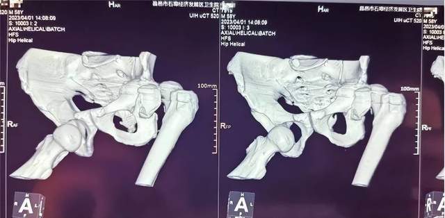 昌邑市石埠经济发展区卫生院精准治疗罕见双侧髋关节脱位