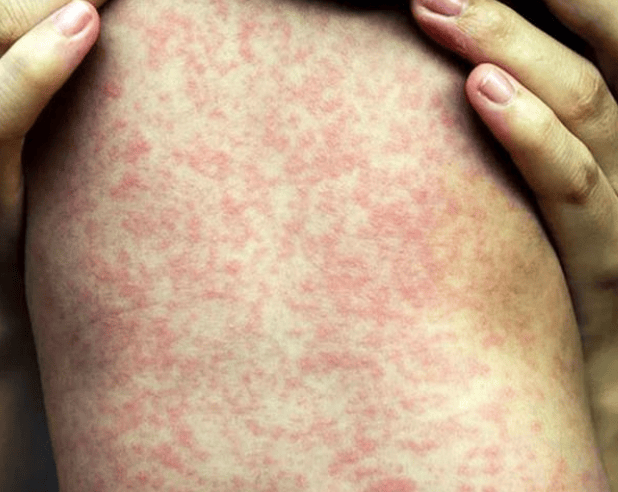 由过敏原引起的皮肤病,表现为红肿,发痒,风团等.