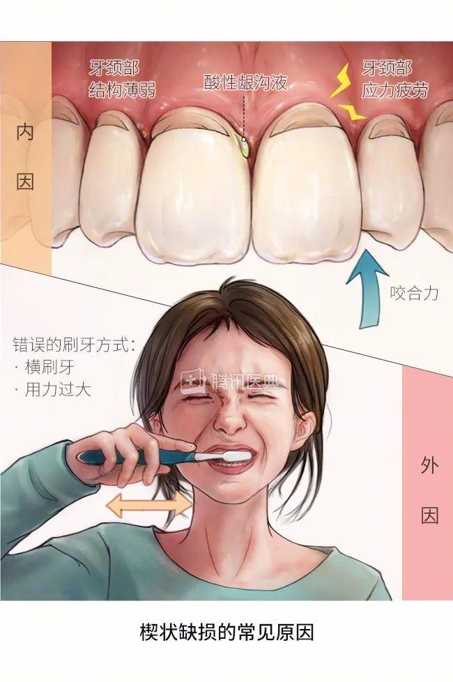 牙齿楔状缺损怎么修复图片