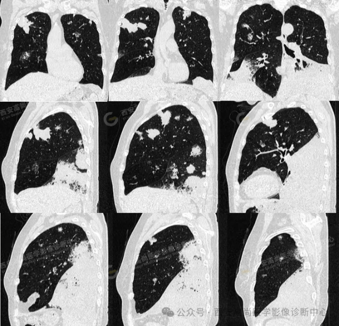 女,63岁,肺粘液腺癌一例