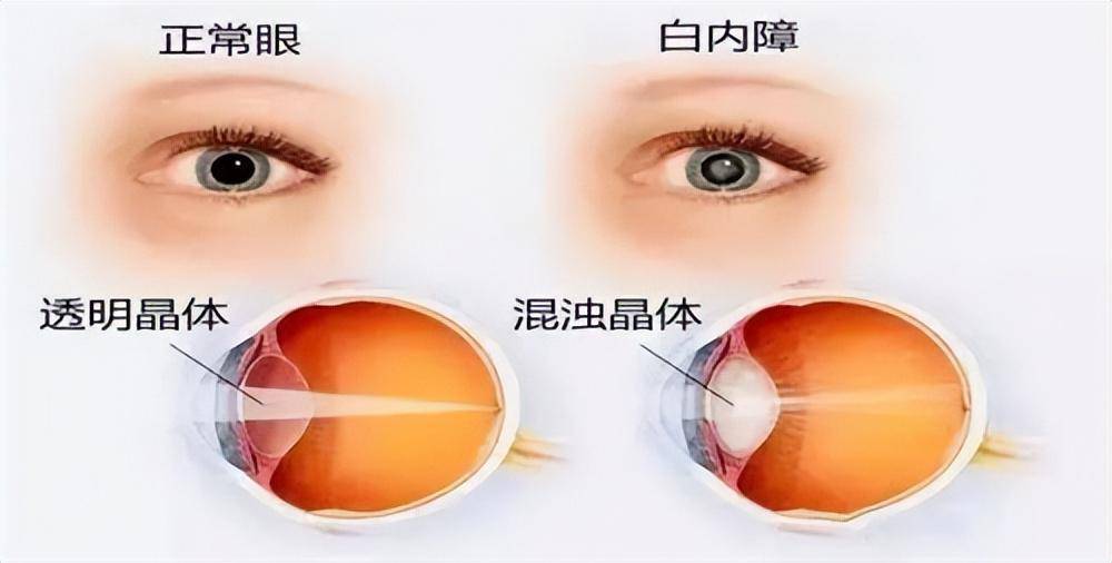 晶状体混浊后,会阻碍外界光线进入眼内,即称为白内障.