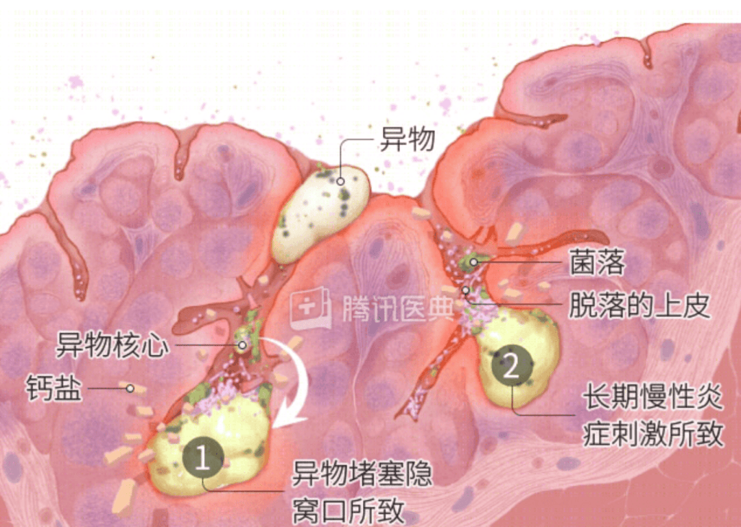 扁桃体白色分泌物图片