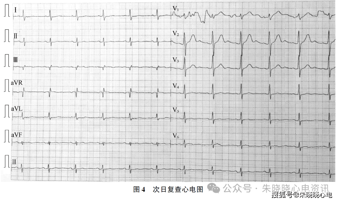 心绞痛心电图变化图片