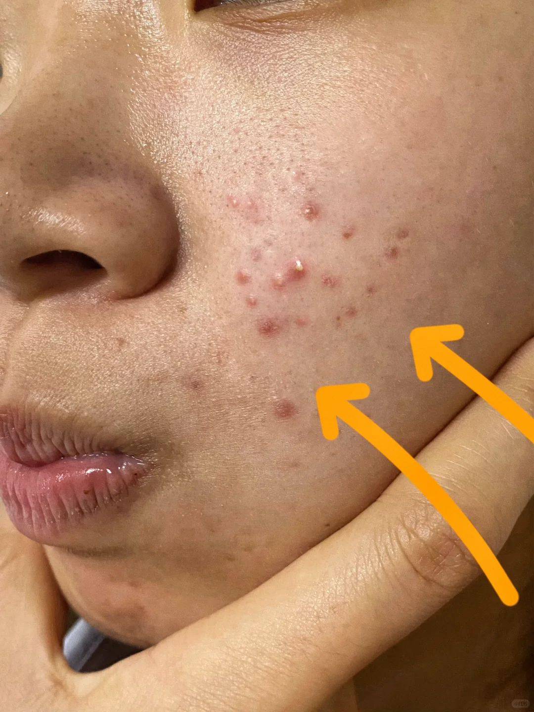 痤疮逐渐消失!记住这几点