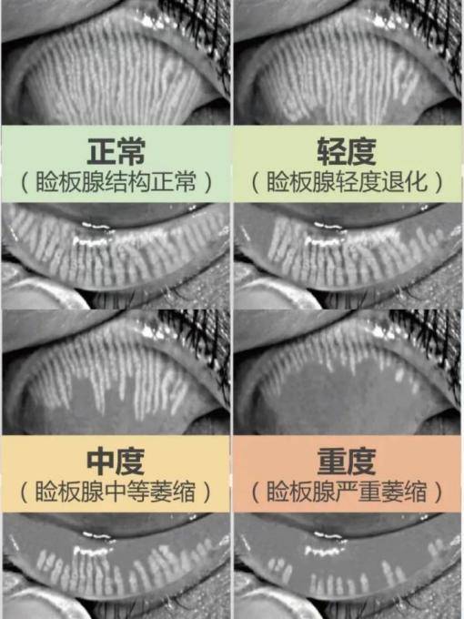 睑缘肥厚图片