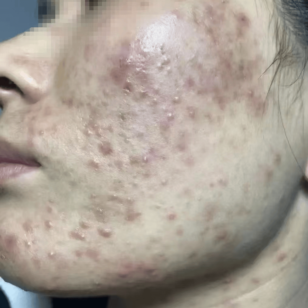 脸上的陈年痘印怎么破!快看按照专业人员说的学!