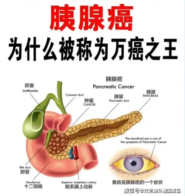 玫克微朵 德国菌菇:如何避开癌中之王胰腺癌?