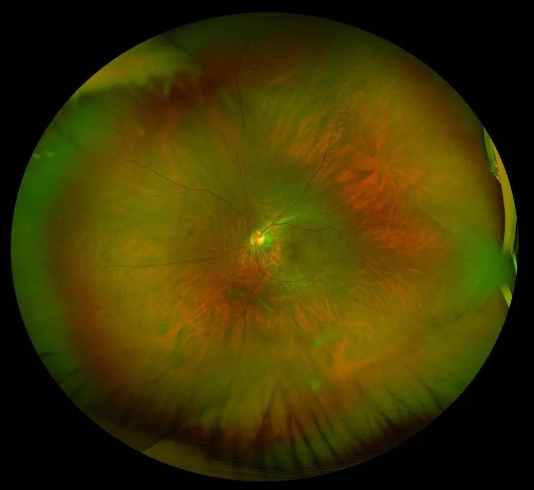 左眼,视轴下方玻璃体大片膜样混浊,可见玻璃体后脱离,视盘边界清晰