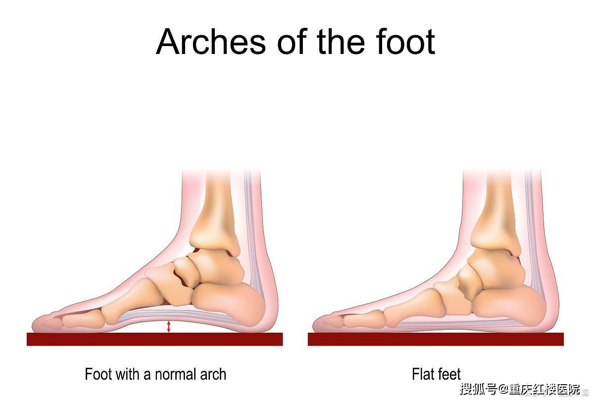 扁平足是怎样形成的图片