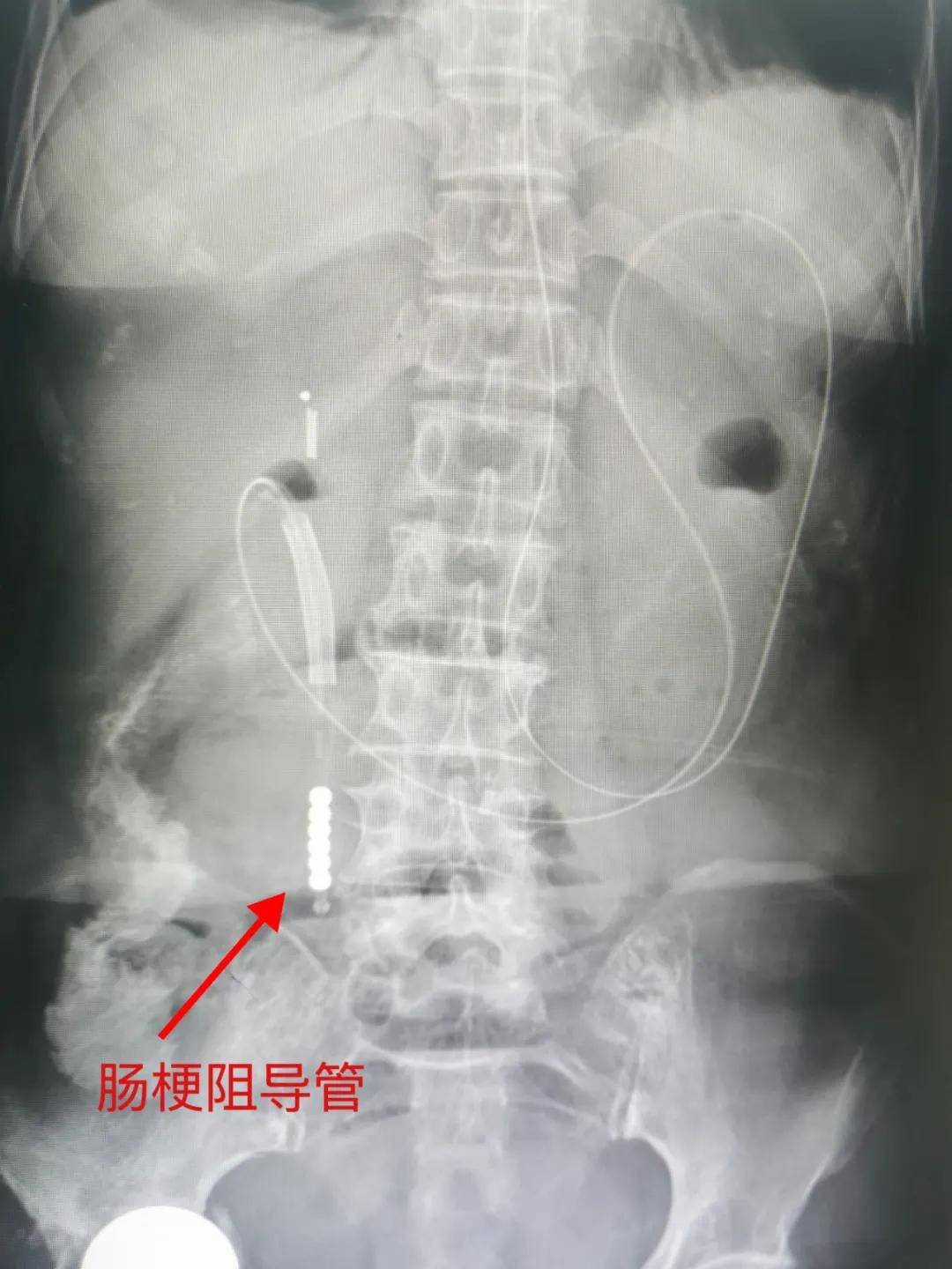 肠梗阻导管厂家图片