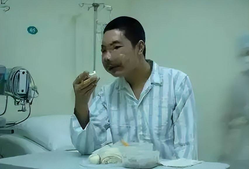 中国换脸第一人李国兴:被熊袭击面部,换脸手术成功半年离奇死亡