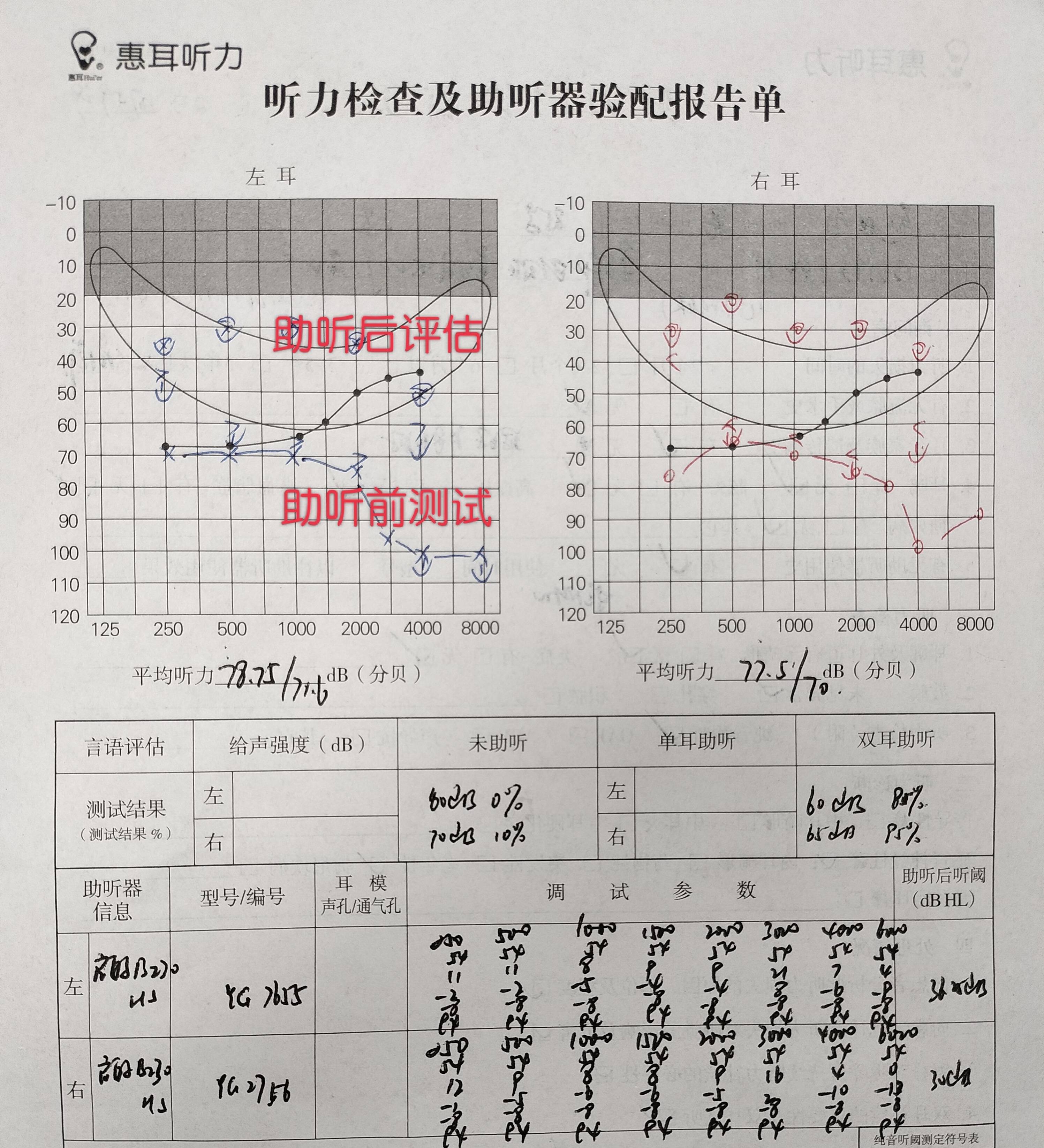 纯音测听结果如下:电耳镜检查:鼓膜正常,耳道无畸形或耵聍堵塞,无炎症