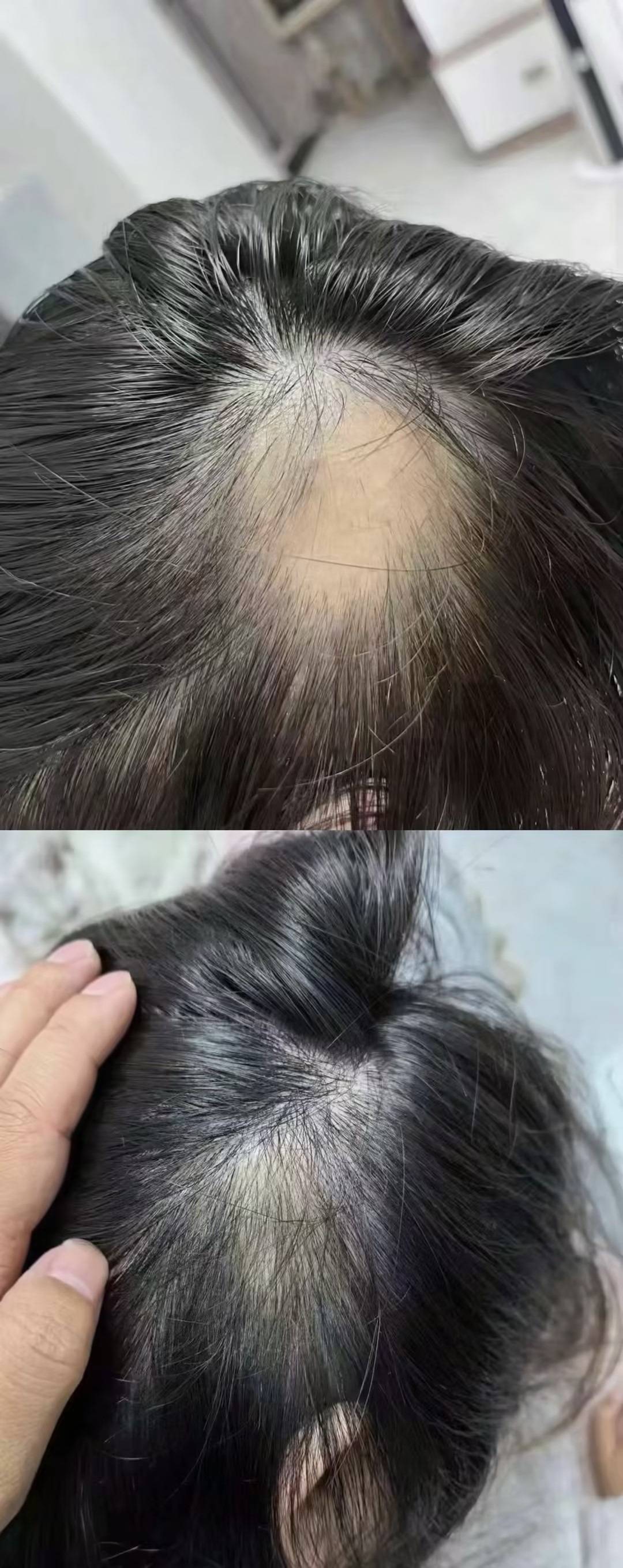 掉头发是因为什么