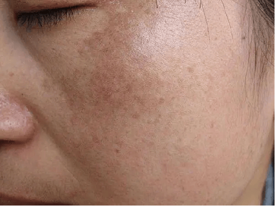 首先肤色不均分为局部肤色不均和全脸肤色不均,局部肤色不均匀主要是