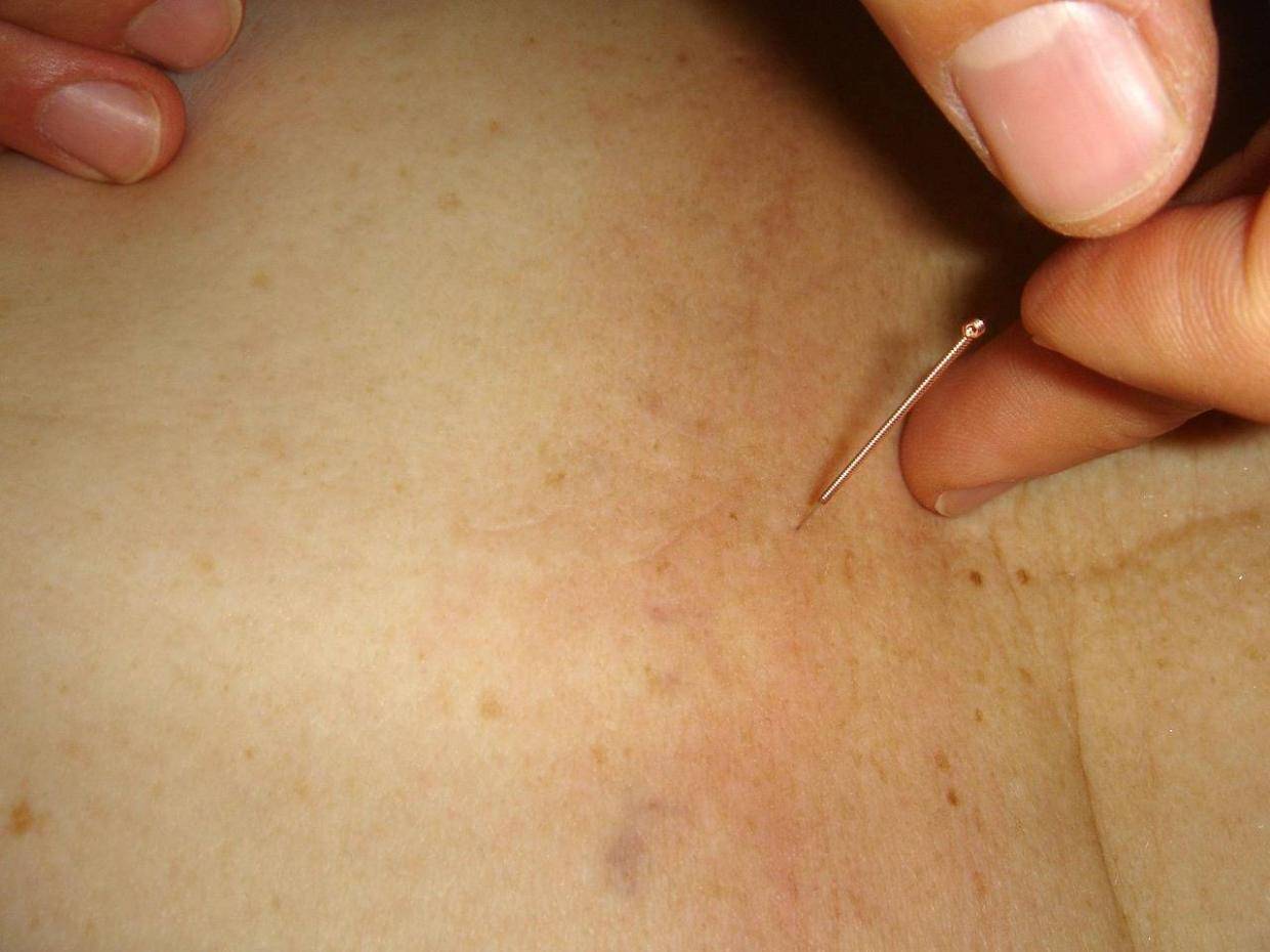 【妙技疗疾】针灸一扎，好孕到家_患者_治疗_子宫