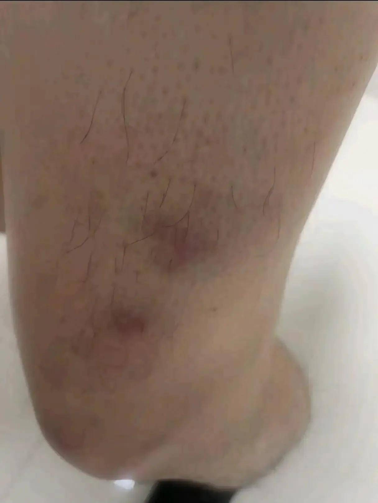 许钟豪赛后晒出被张宁顶膝造成的淤青,或许这才是触发他违体原因