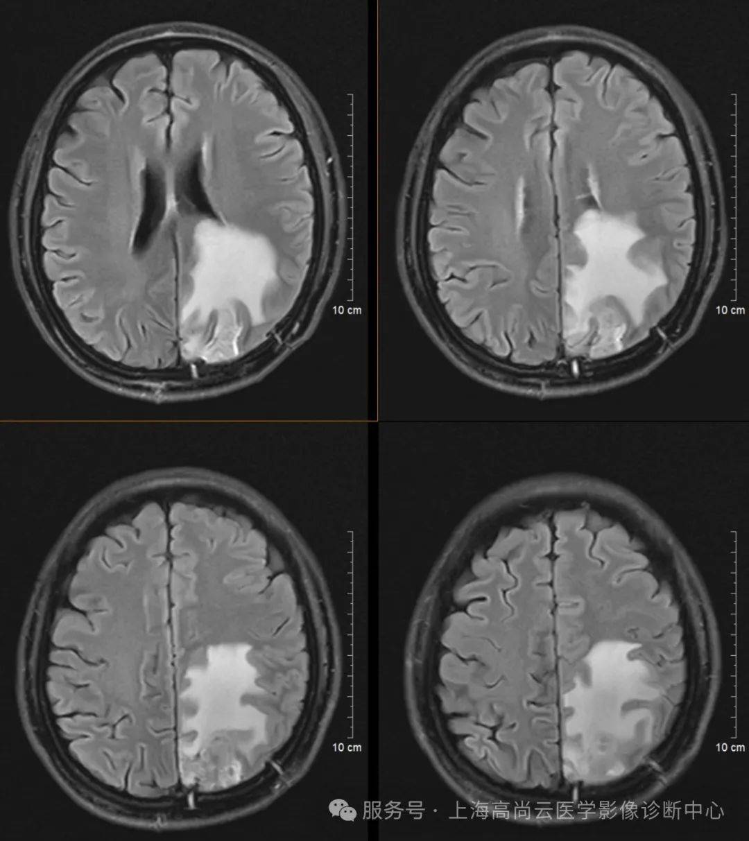 多参数mr综合评估肺癌脑转移