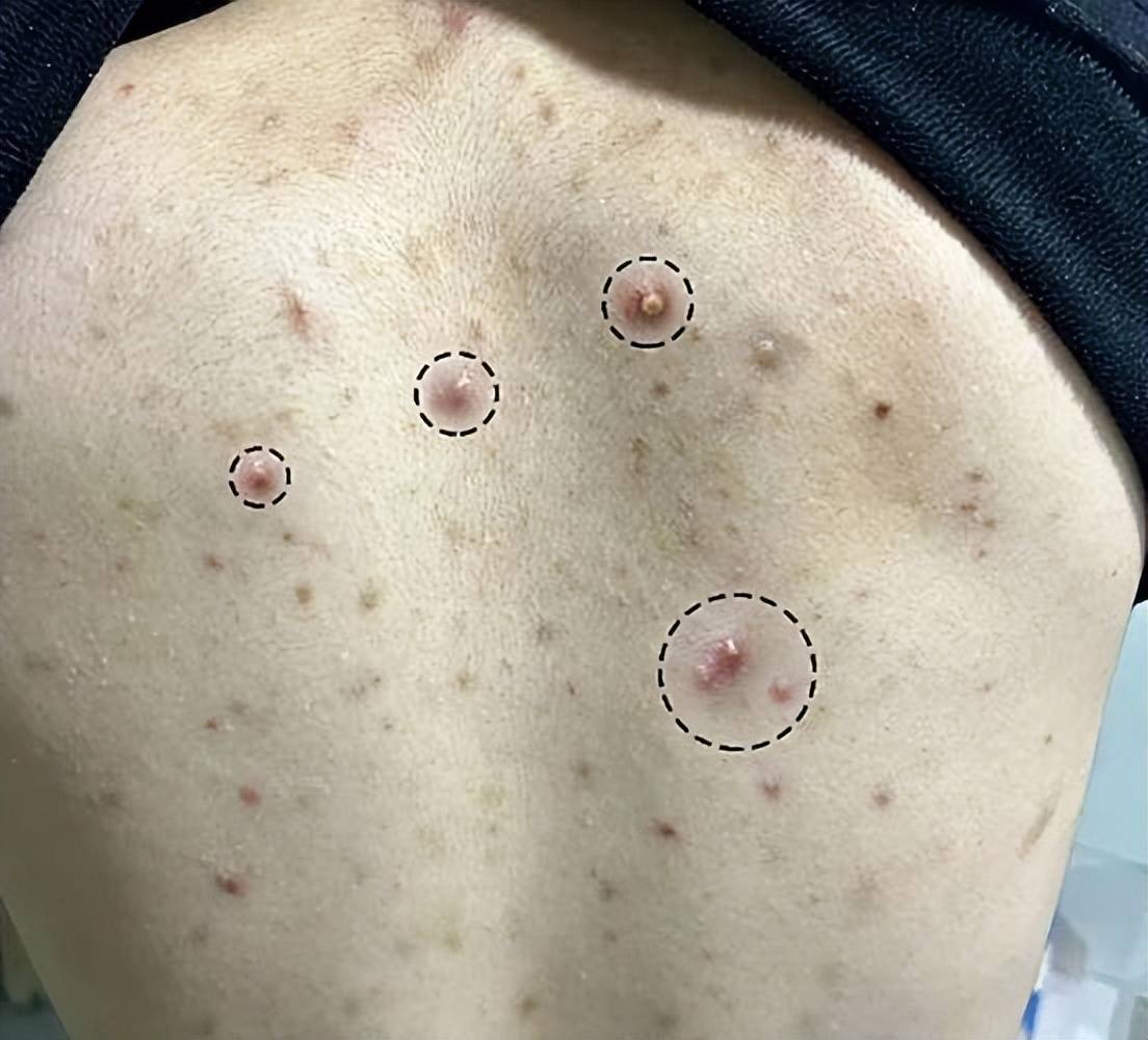 13岁男孩眼里揪出80多只活螨虫!医生提醒:这种生活习惯最招虫!