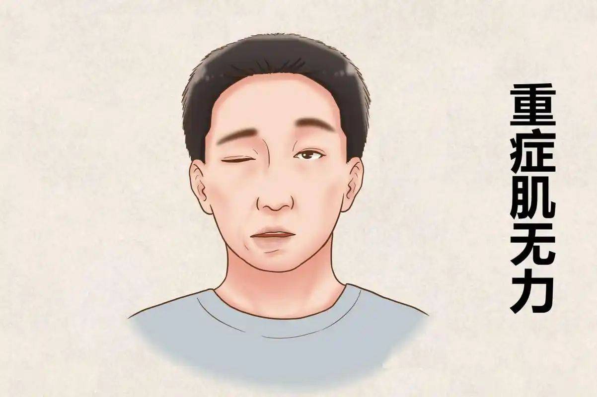 走进神经内科,揭开重症肌无力各类型的神秘"面纱"