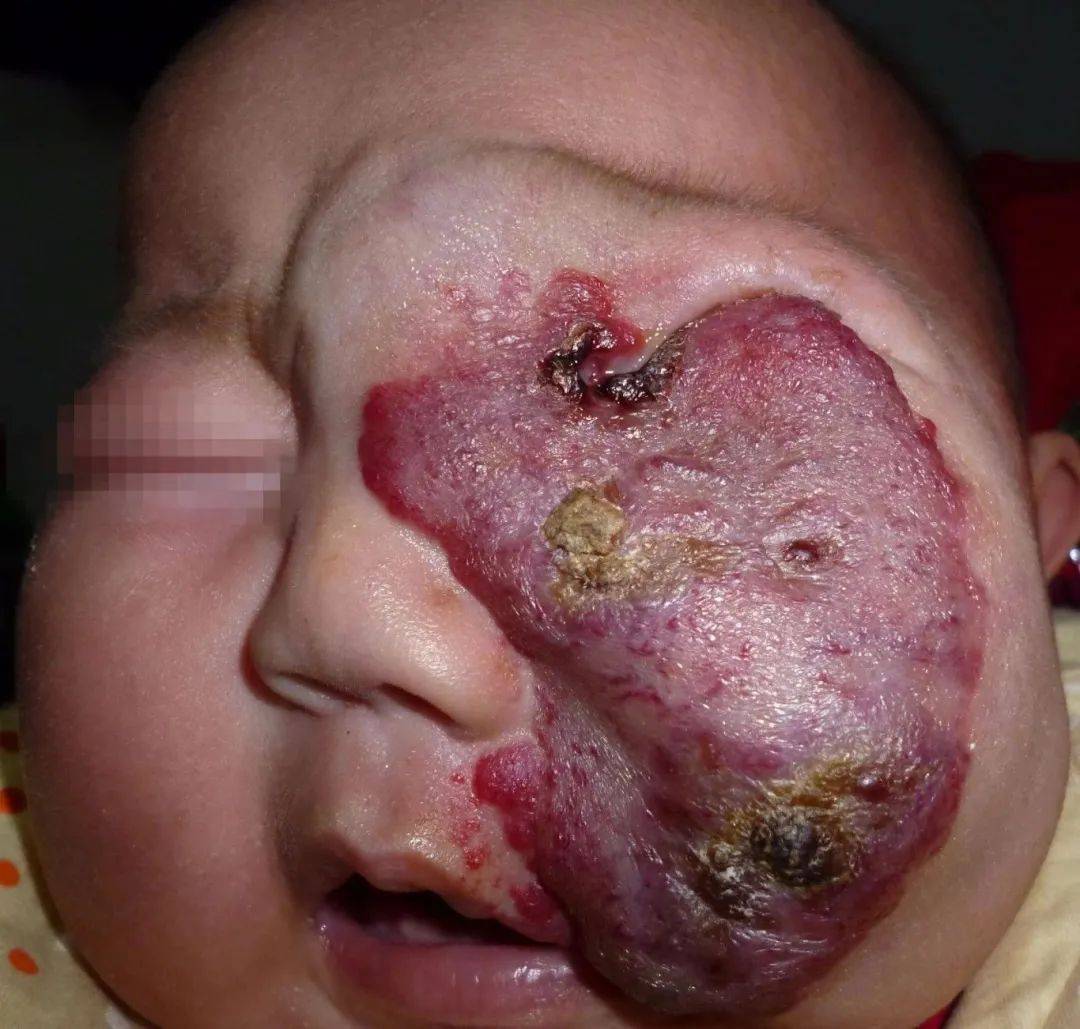 "揭秘血管瘤:对患儿健康的隐形威胁,远比想象更为复杂,早知早防,守护