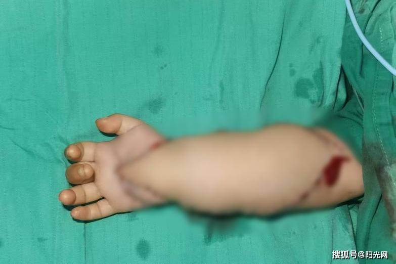 断肢重建 再造生命"手"护力