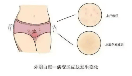 贵阳良方外阴白斑医院:患上外阴白斑,一定会外阴瘙痒吗