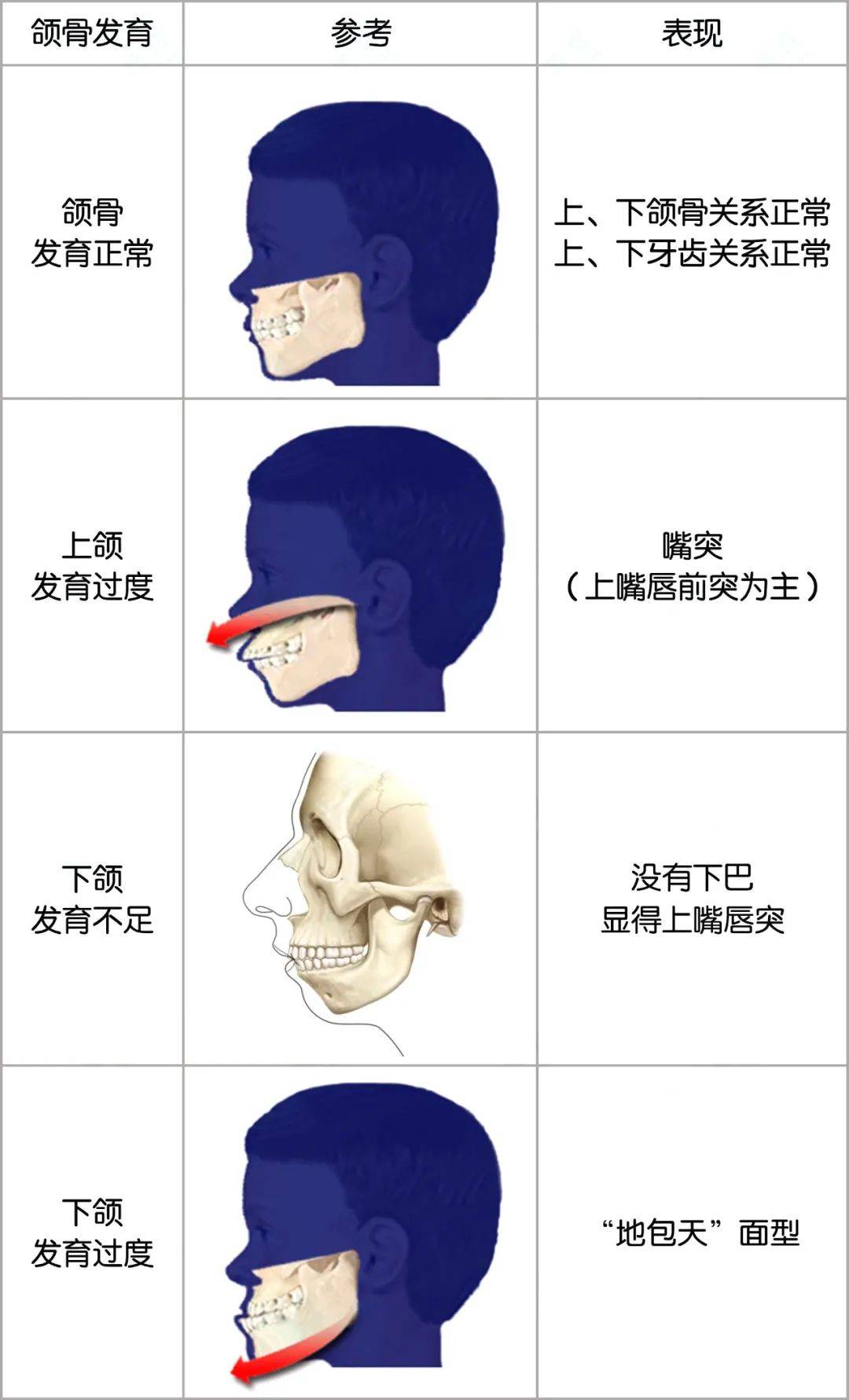深入解析牙齿前突