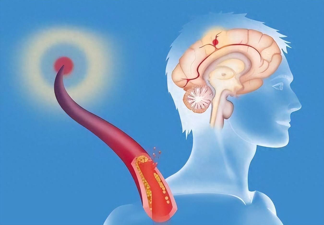 How many seconds does cerebral embolism cause you hemiplegia