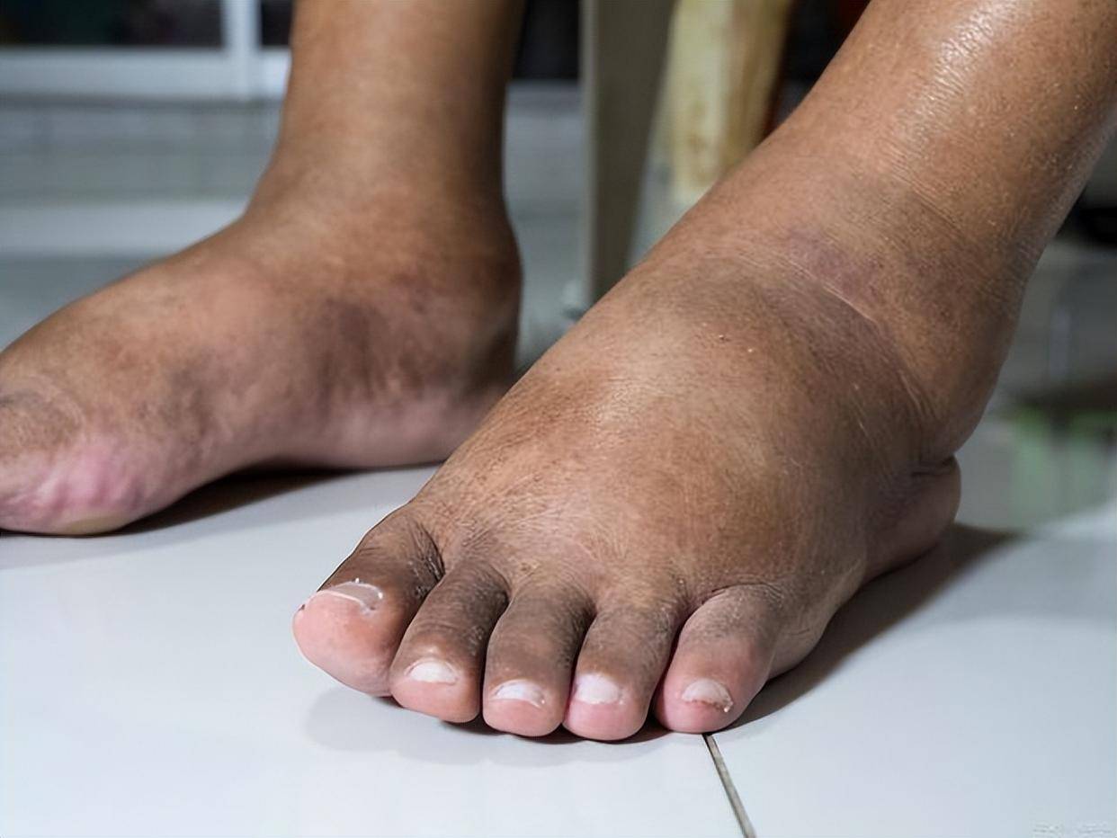 原创大病来前脚先知提醒快看看你的脚有这6个症状别忽视