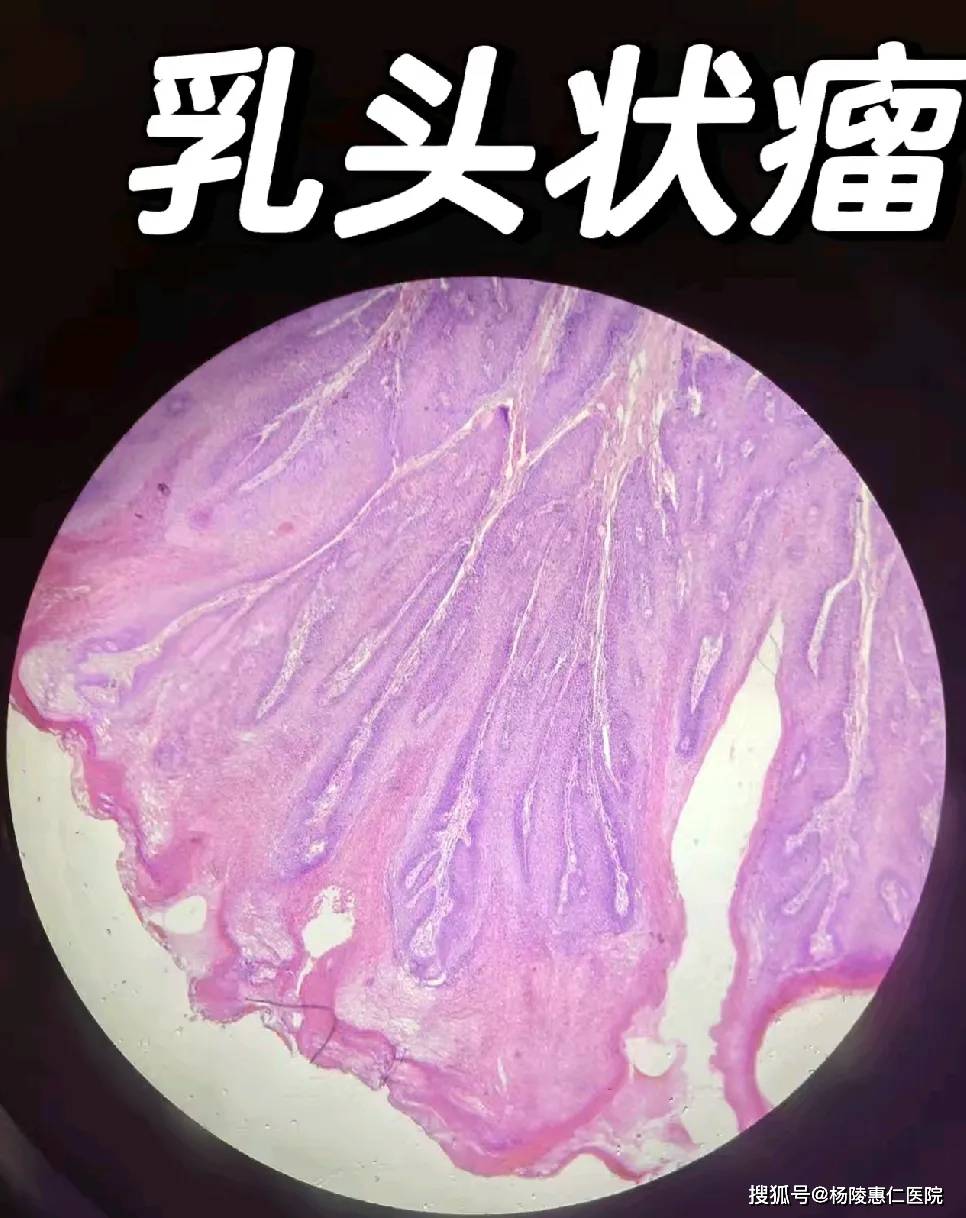 如果感觉咽部有持续异物感,别忽视,及时就医检查,才能让咽喉保持舒适